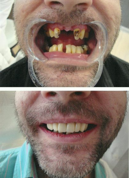 Εμφυτεύματα δοντιών