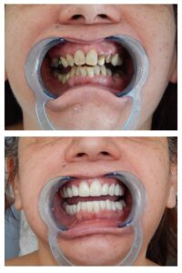 Lifting Δοντιών & Προσθετική με ολοκεραμικά