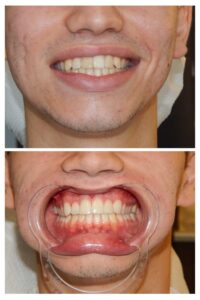 Όψεις Ρητίνης Πριν Μετά